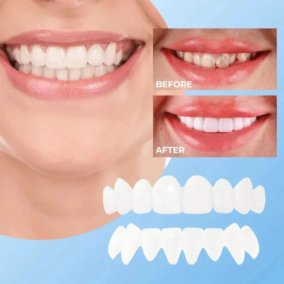 Lonryd SmileFlex™ Veeners